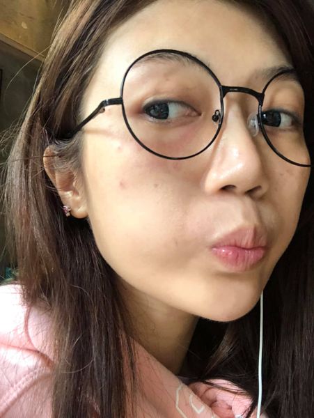【皮秒雷射】星采整形外科診所(大安)-為了想要皮膚更好，定期打皮秒雷射是很重要的！！～-甜美女孩-星岑